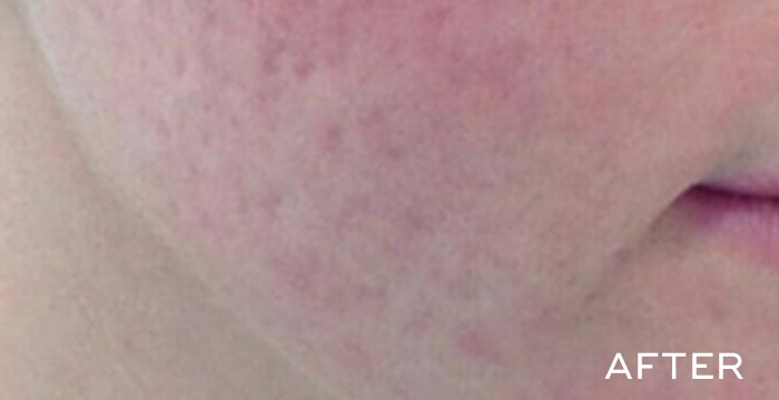 After Balense skincare acne 2