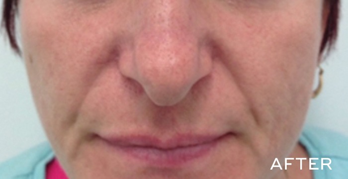 After Balense skincare ageing 1
