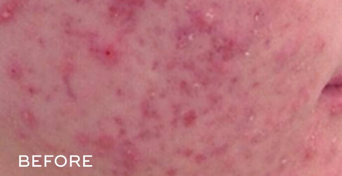 Before Balense skincare acne 2